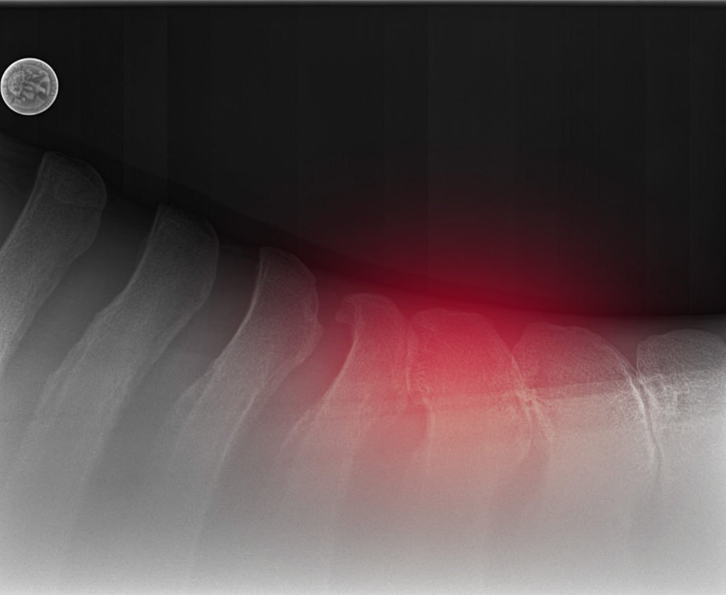 highlighted kissing spine